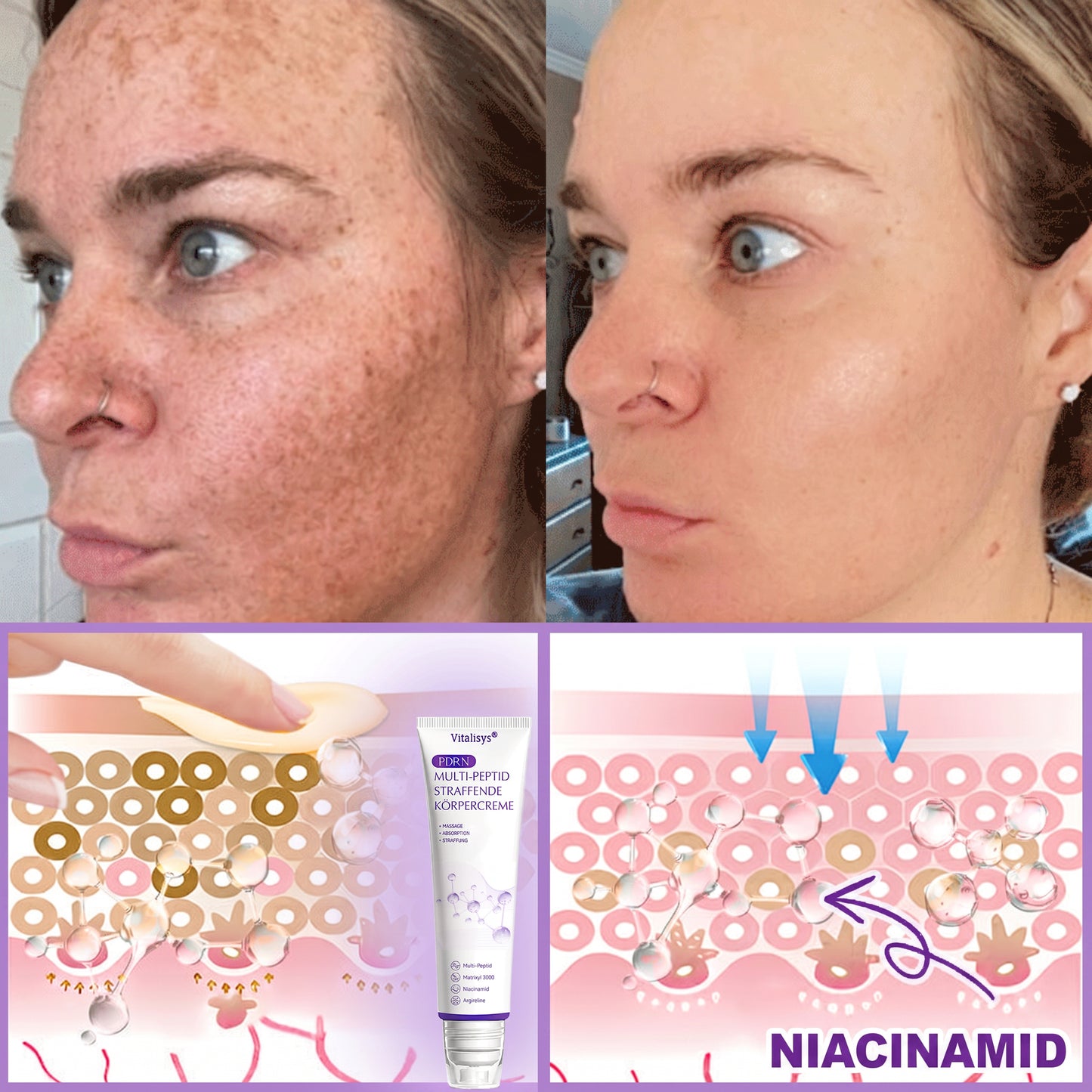 💎FDA-zertifiziert: Vitalisys® PDRN Multi-Peptide Massaging Body Roller Cream – Anti-Aging, Feuchtigkeit, Hautstraffung & Lifting, Hautpflege, ebenmäßiger Hautton, Akne- & Fleckenpflege, Warzen- & Muttermalentfernung, Psoriasis-Linderung.🍇