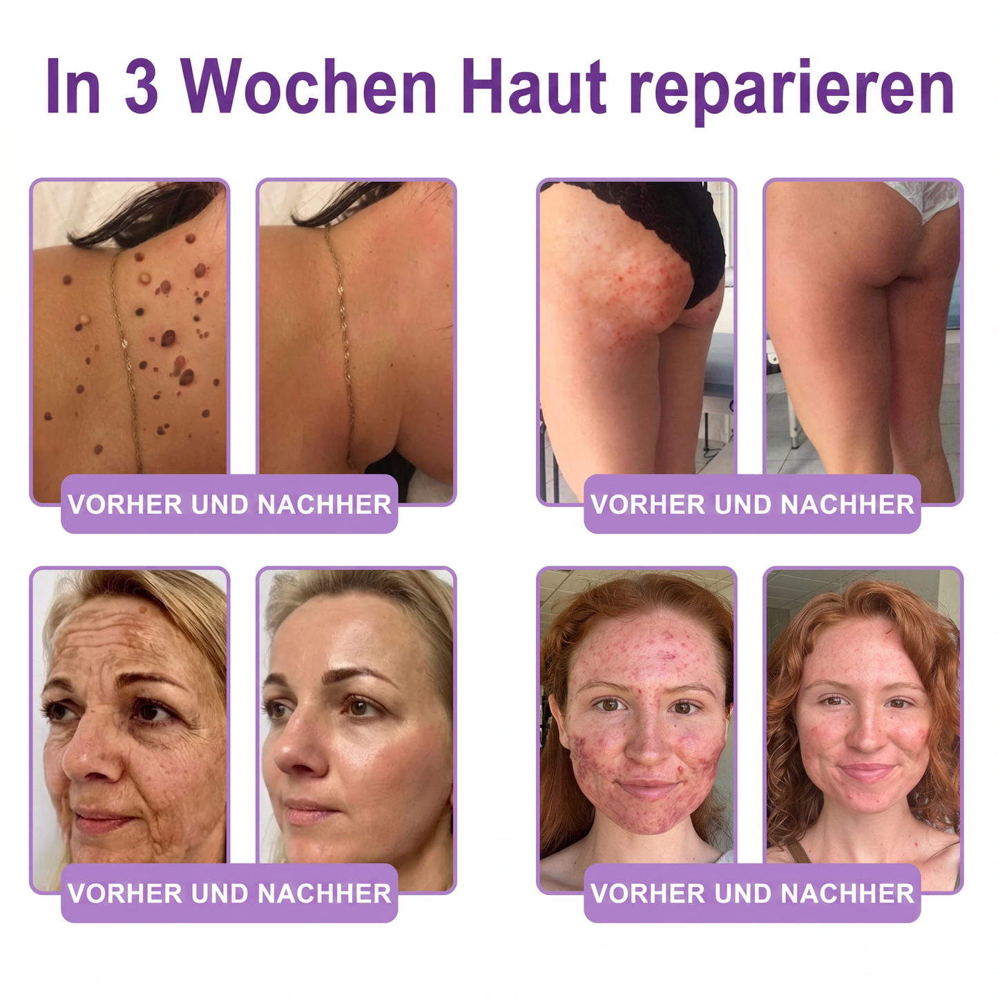 💎FDA-zertifiziert: Vitalisys® PDRN Multi-Peptide Massaging Body Roller Cream – Anti-Aging, Feuchtigkeit, Hautstraffung & Lifting, Hautpflege, ebenmäßiger Hautton, Akne- & Fleckenpflege, Warzen- & Muttermalentfernung, Psoriasis-Linderung.🍇