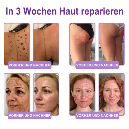 💎FDA-zertifiziert: Vitalisys® PDRN Multi-Peptide Massaging Body Roller Cream – Anti-Aging, Feuchtigkeit, Hautstraffung & Lifting, Hautpflege, ebenmäßiger Hautton, Akne- & Fleckenpflege, Warzen- & Muttermalentfernung, Psoriasis-Linderung.🍇