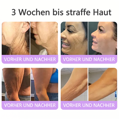 💎FDA-zertifiziert: Vitalisys® PDRN Multi-Peptide Massaging Body Roller Cream – Anti-Aging, Feuchtigkeit, Hautstraffung & Lifting, Hautpflege, ebenmäßiger Hautton, Akne- & Fleckenpflege, Warzen- & Muttermalentfernung, Psoriasis-Linderung.🍇