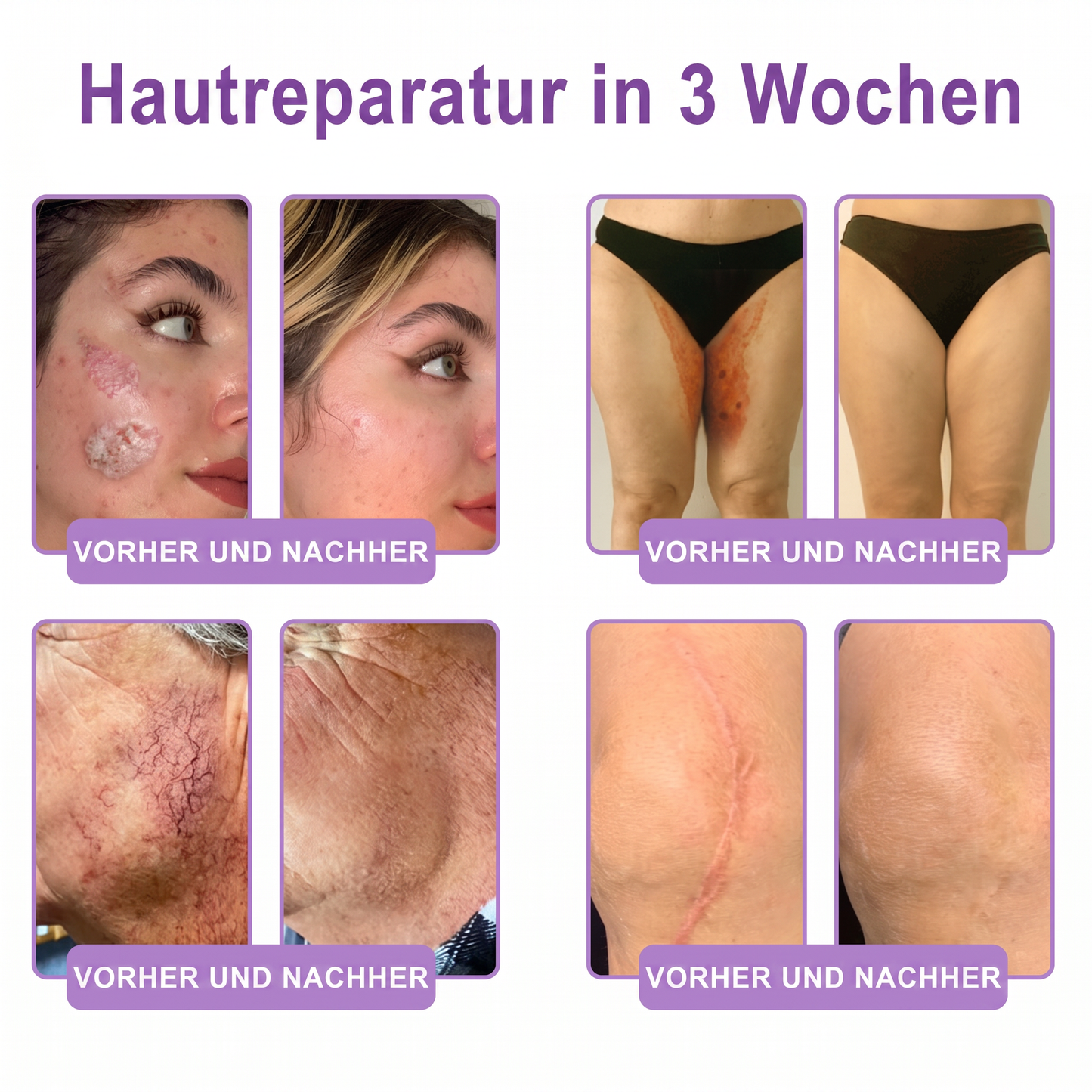 💎FDA-zertifiziert: Vitalisys® PDRN Multi-Peptide Massaging Body Roller Cream – Anti-Aging, Feuchtigkeit, Hautstraffung & Lifting, Hautpflege, ebenmäßiger Hautton, Akne- & Fleckenpflege, Warzen- & Muttermalentfernung, Psoriasis-Linderung.🍇