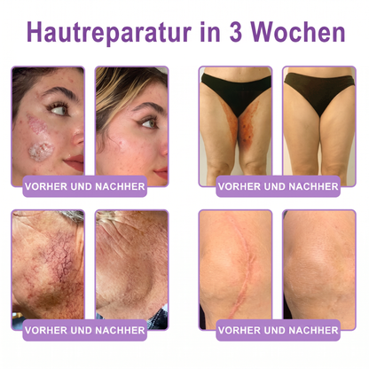 💎FDA-zertifiziert: Vitalisys® PDRN Multi-Peptide Massaging Body Roller Cream – Anti-Aging, Feuchtigkeit, Hautstraffung & Lifting, Hautpflege, ebenmäßiger Hautton, Akne- & Fleckenpflege, Warzen- & Muttermalentfernung, Psoriasis-Linderung.🍇
